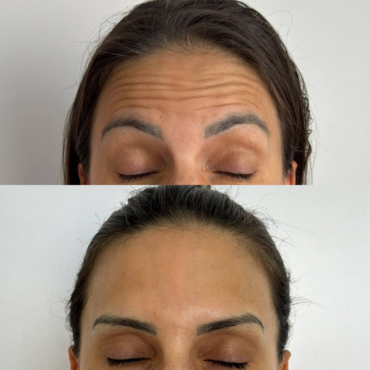 Resultado Botox 1