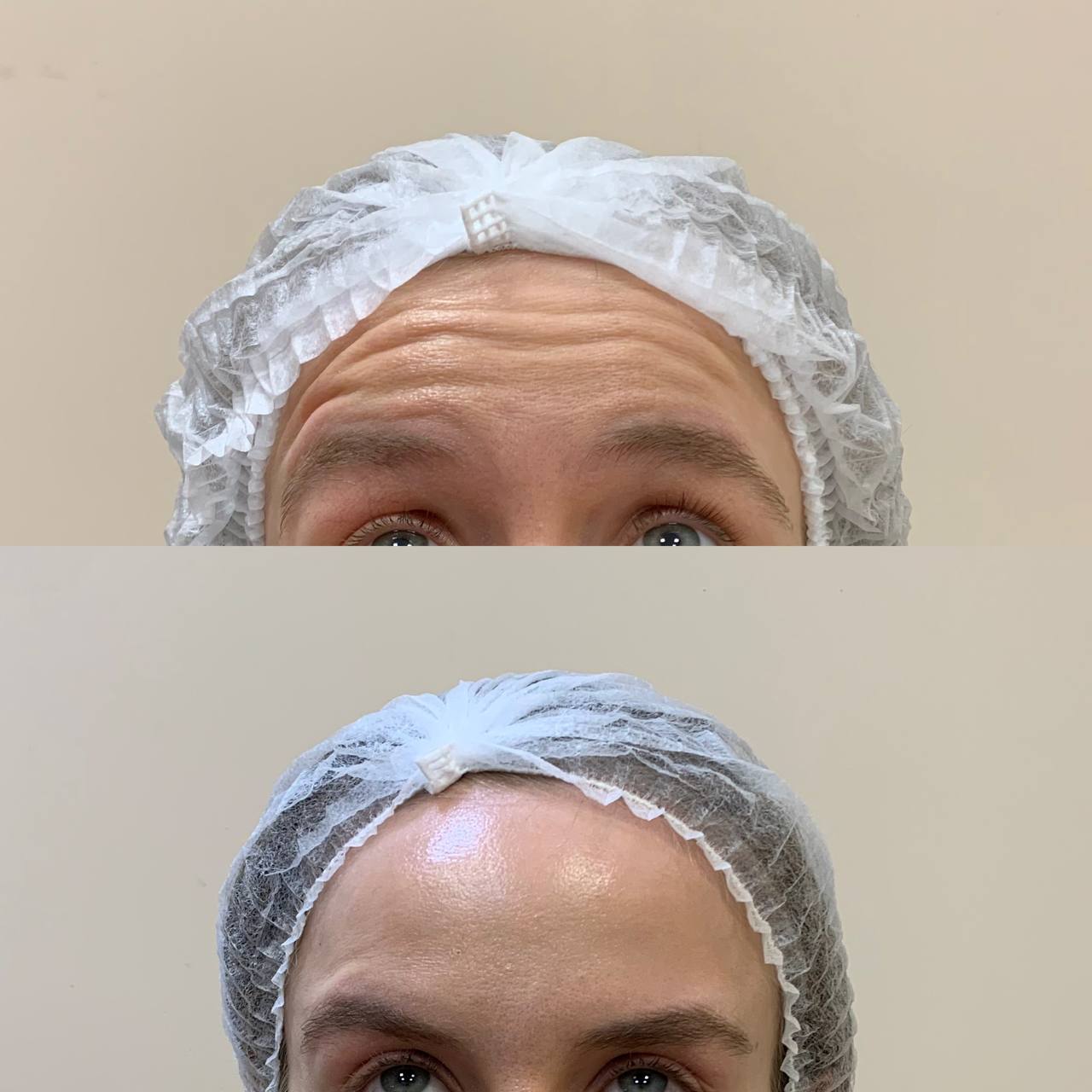 Resultado Botox 2