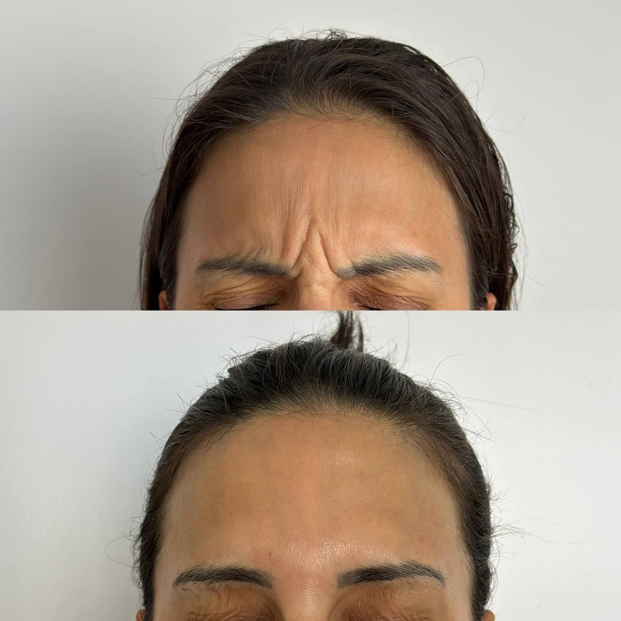 Resultado Botox 3