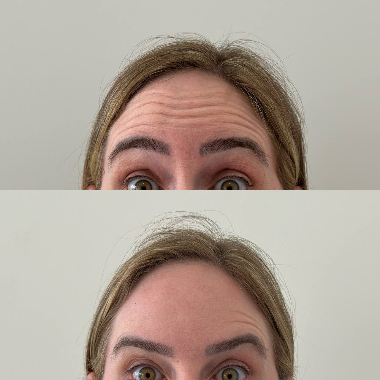 Resultado Botox 4