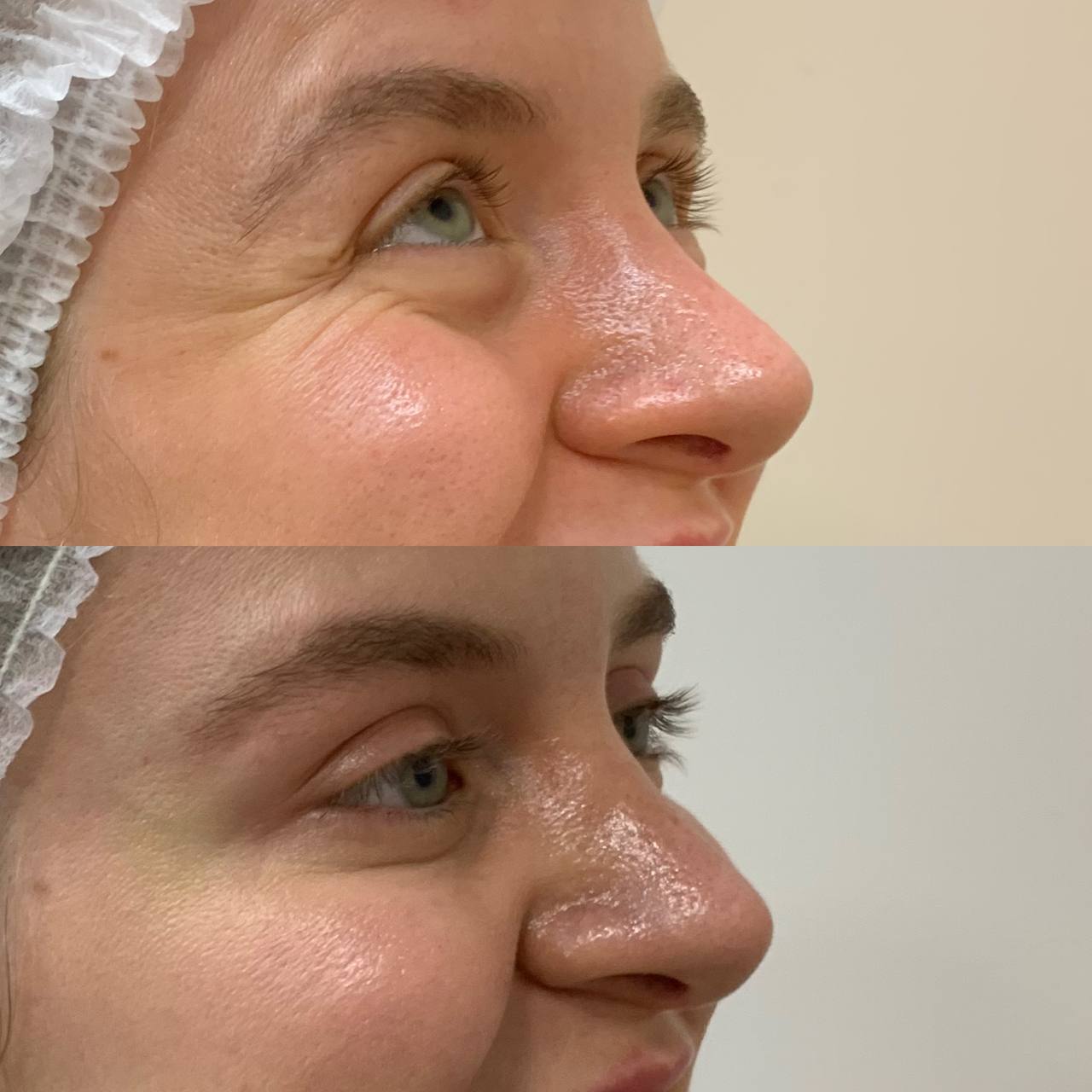Resultado Botox 5