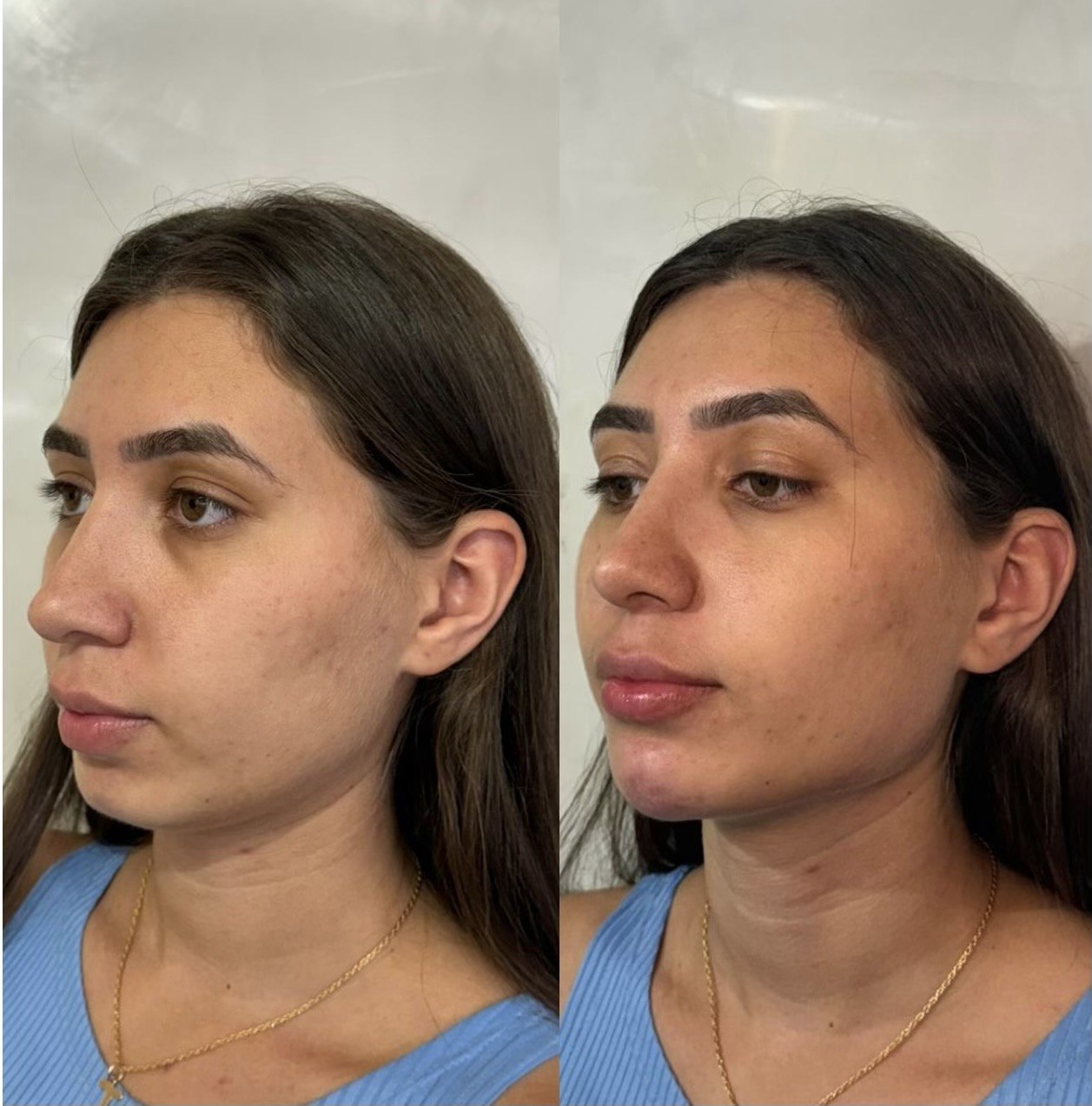 Resultado Harmonização 1