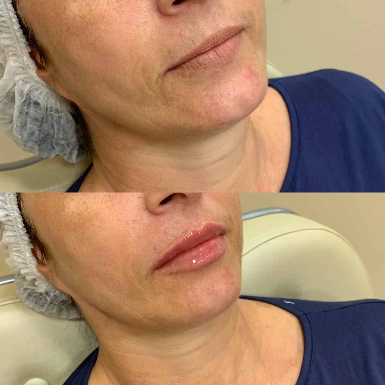 Resultado Preenchimento Labial 2