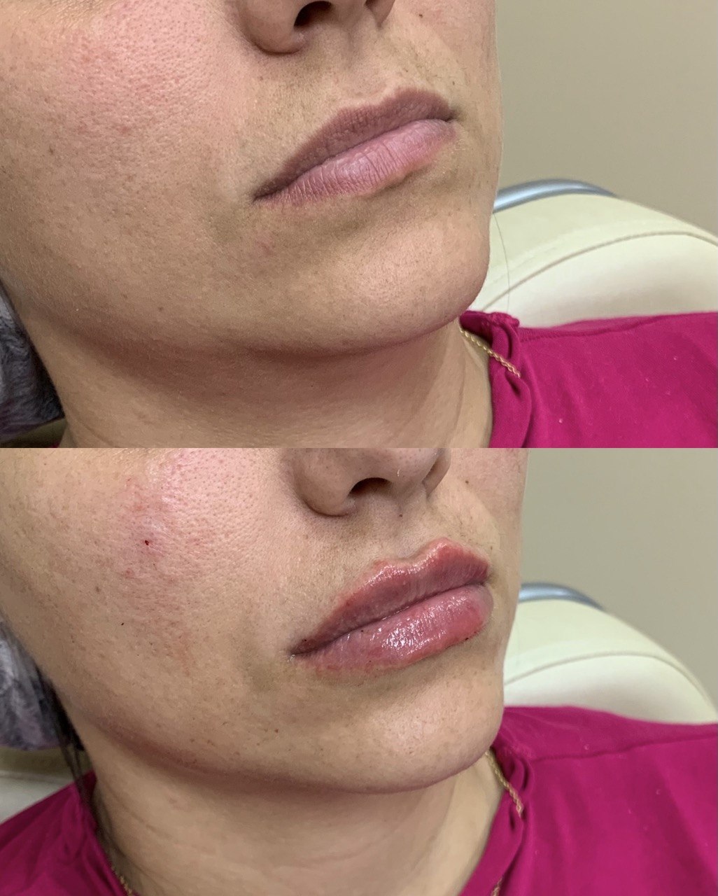 Resultado Preenchimento Labial 3