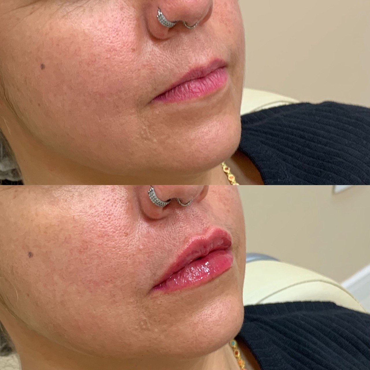 Resultado Preenchimento Labial 4